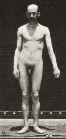 Plate 557 Local chorea, standing — figure reference